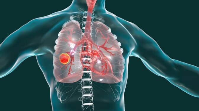 Diagnosticar el cáncer de pulmón en su fase inicial aumenta drásticamente la supervivencia a largo plazo 