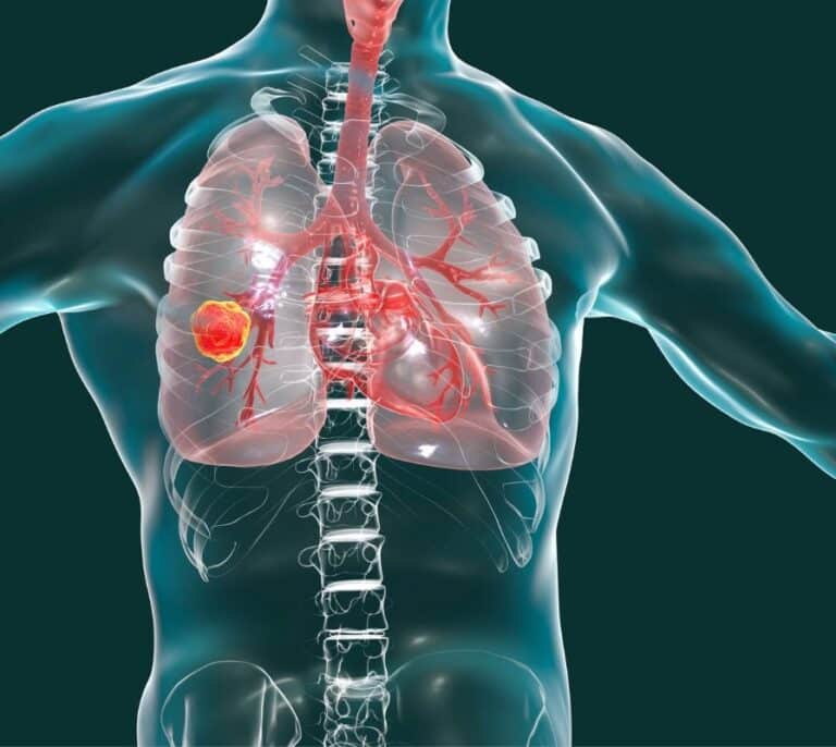 El cribado por tomografía computarizada del cáncer de pulmón aumenta drásticamente la supervivencia a largo plazo