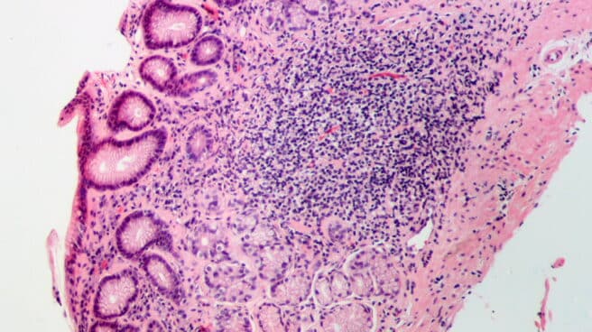 Gastritis. Gastritis.