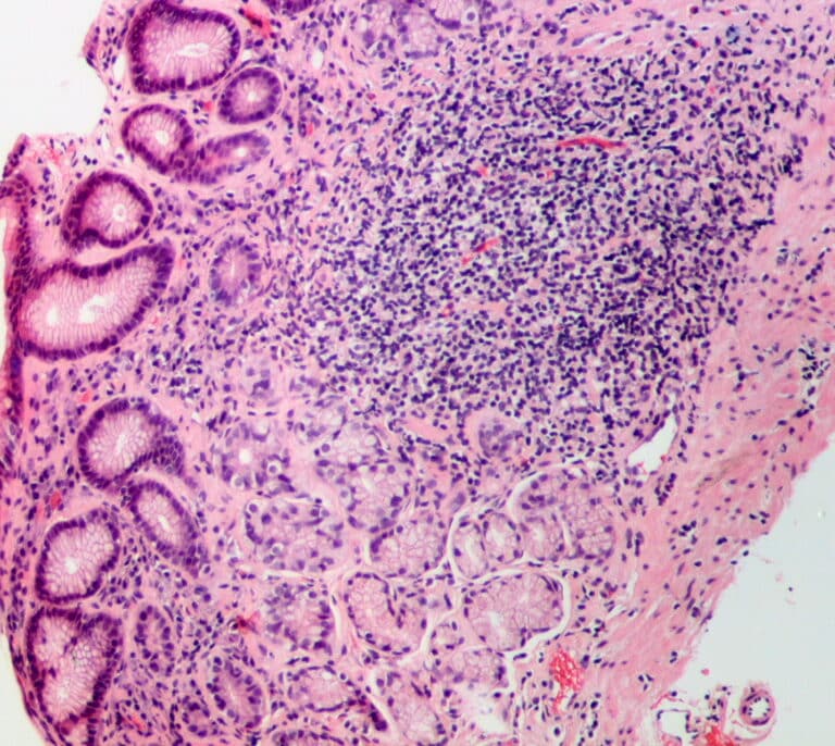 Inteligencia artificial para detectar lesiones previas al cáncer gástrico