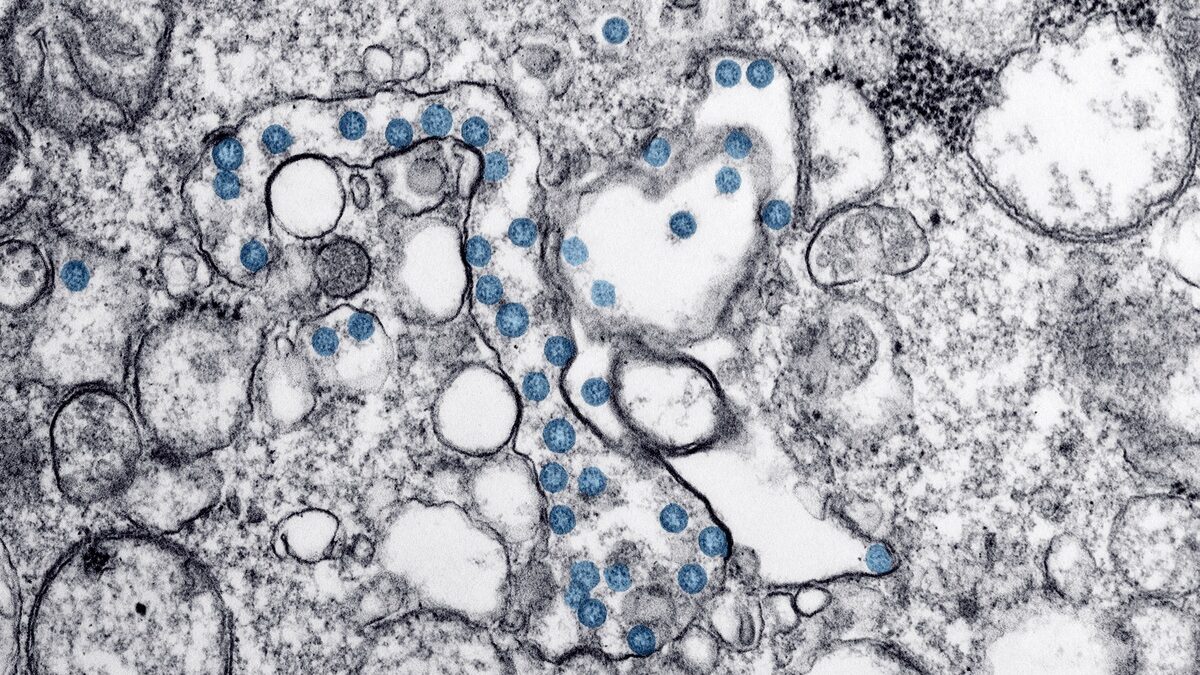 Partículas del virus SARS-CoV-2, coloreadas en azul, en una imagen de microscopio de electrones.