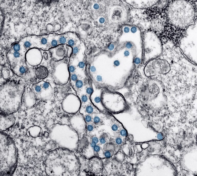 La clave para tratar el covid persistente está en las células zombies, según un estudio del CSIC