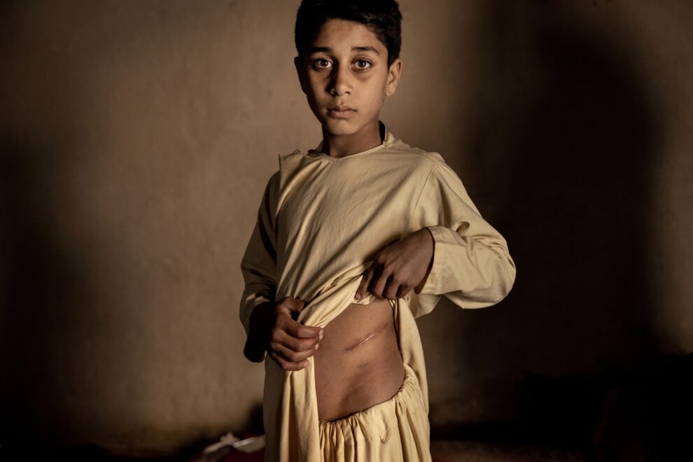 Khalil Ahmad muestra su cicatriz de la operación por la que vendieron su riñon.
