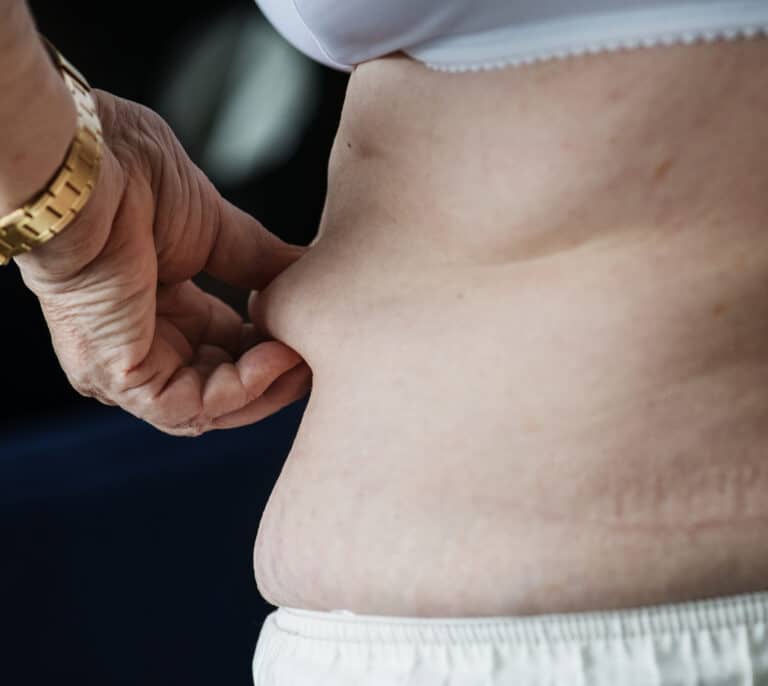 Operan en Barcelona a una mujer de 300 kilos por "falta de medios" en Galicia