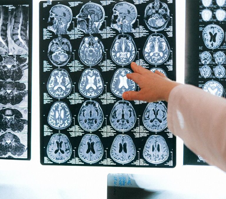 Guerra por el lecanemab: el polémico fármaco contra el alzhéimer aprobado en EE.UU y rechazado en la UE