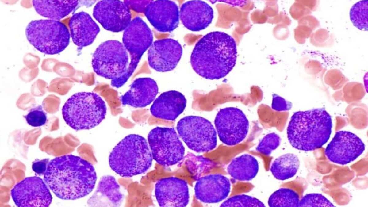 Un tratamiento de Gilead mejora la supervivencia en pacientes con linfoma B