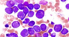 Un tratamiento de Gilead mejora la supervivencia en pacientes con linfoma B