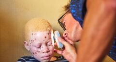 ISDIN ayuda a las personas con albinismo de Mozambique a luchar contra el cáncer de piel