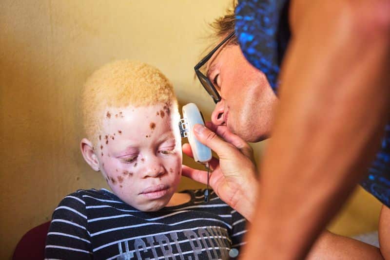 Dermatólogos de diferentes países se desplazan a Mozambique para ayudar a las personas con albinismo a combatir el cáncer de piel