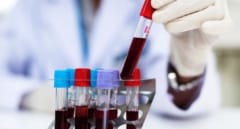 El fármaco Zanubrutinib para el tratamiento de leucemia linfocítica se usará en Reino Unido e Irlanda