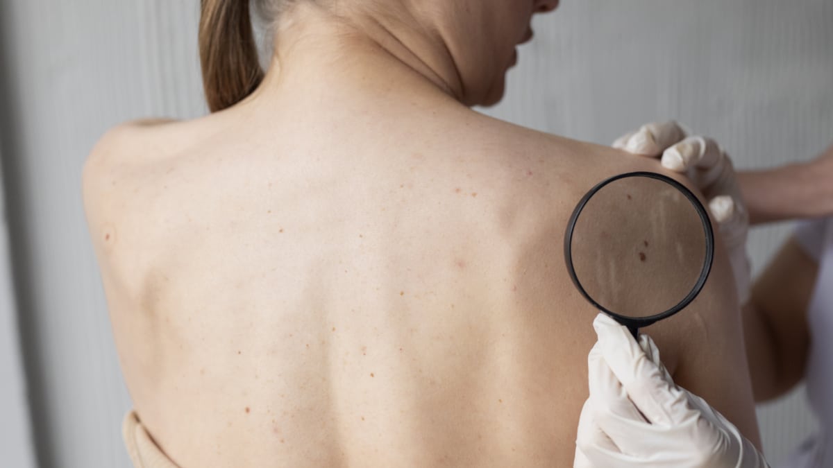 Un innovador tratamiento para borrar las primeras lesiones del cáncer de piel