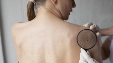 Un innovador tratamiento para borrar las primeras lesiones del cáncer de piel