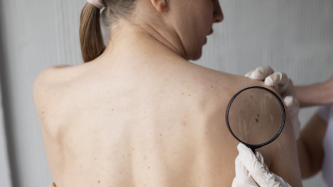 doctora-diagnosticando-melanoma-cuerpo-paciente