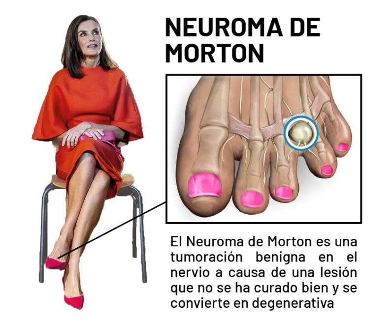 La reina Letizia fue diagnosticada con el neuroma de Morton en 2022.