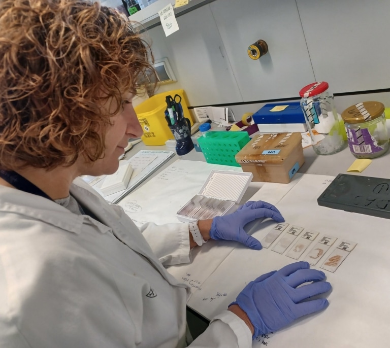 Investigadores españoles identifican una nueva forma genética de alzhéimer