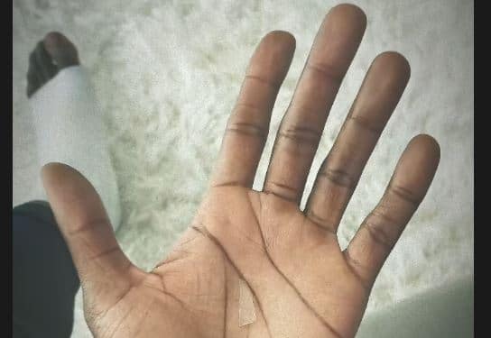 Extraen un cristal de 2 centímetros del pie de Iñaki Williams después de dos años
