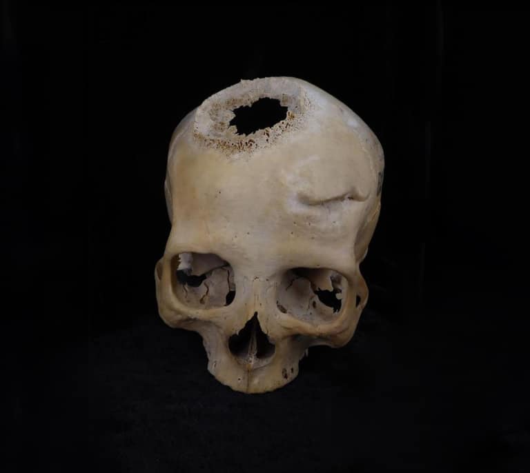 El extraño cráneo que ha destapado la primera cirugía de cáncer de la historia en el Antiguo Egipto
