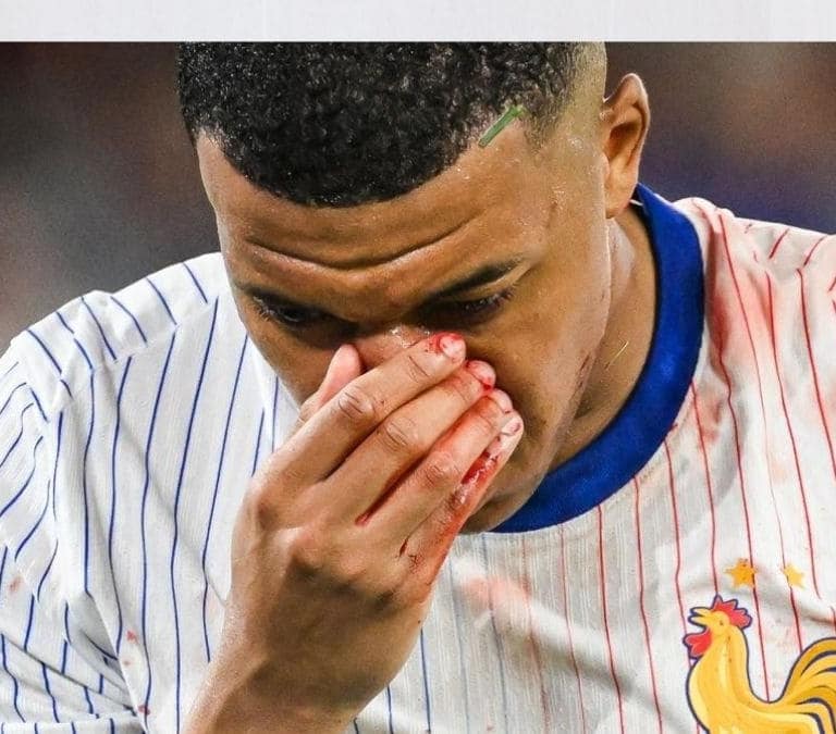Cómo curar una fractura de nariz como la sufrida por Mbappé