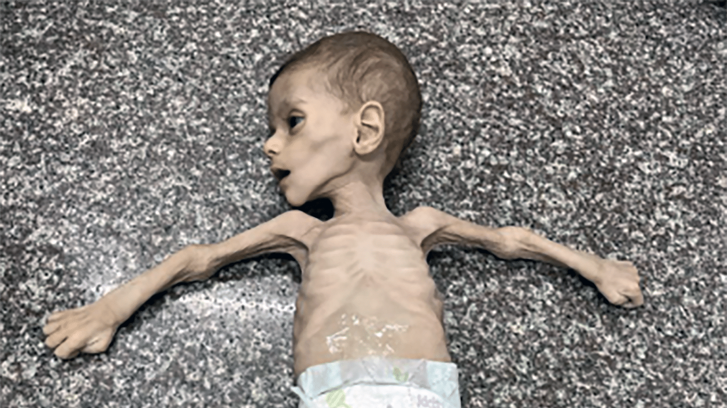 El hambre se cobra las primeras muertes en Gaza