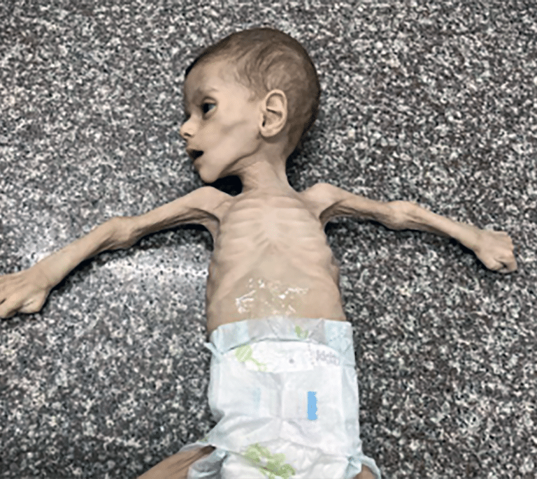 El hambre se cobra las primeras muertes en Gaza