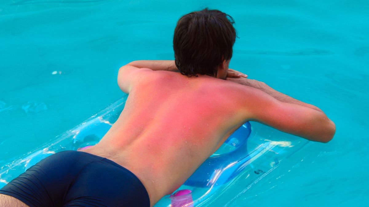 Quemaduras solares