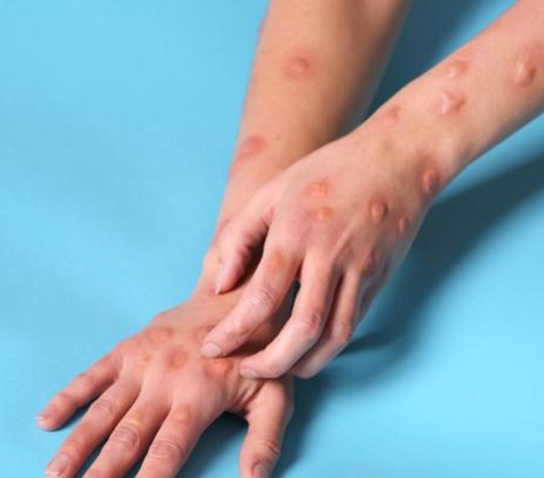 Por qué la viruela del mono se llama ahora mpox, ¿existe vacuna?