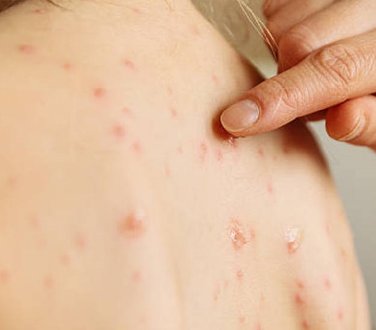 Viruela del mono (mpox): qué es, cómo se transmite, síntomas, nueva variante y medidas preventivas