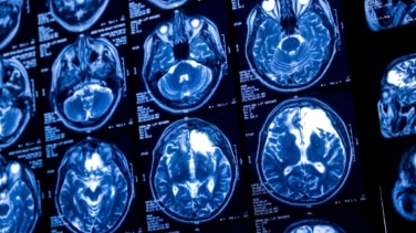 Una de cada cinco personas con epilepsia padece depresión o ansiedad, pudiendo afectar al tratamiento