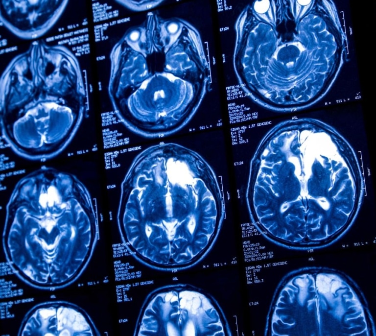 Una de cada cinco personas con epilepsia padece depresión o ansiedad, pudiendo afectar al tratamiento