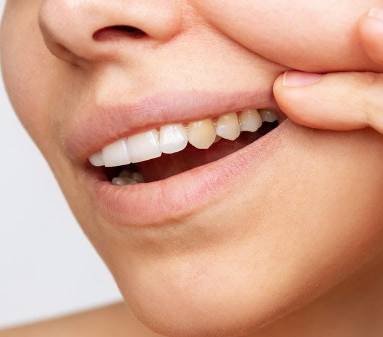 Estos son los alimentos que dañan tus dientes y son mucho peor que el azúcar