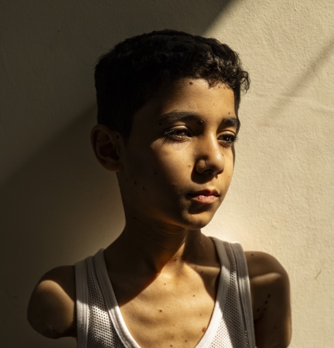 Mahmoud, un niño mutilado de Gaza, foto del año del World Press Photo