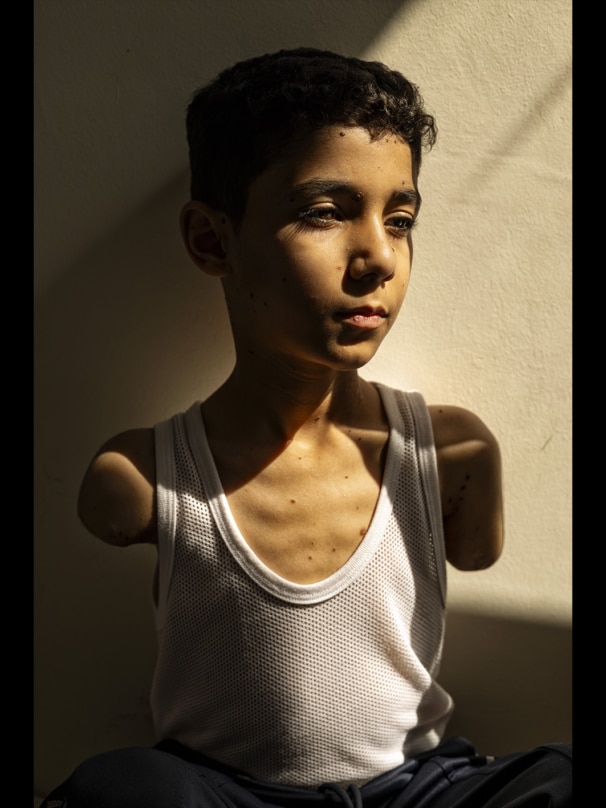 Mahmoud, un niño mutilado de Gaza, foto del año del World Press Photo