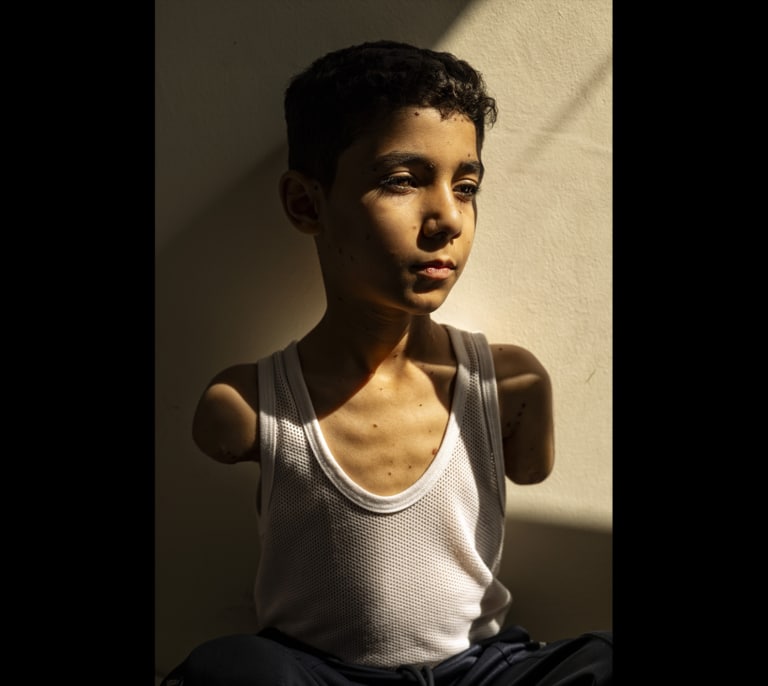 Mahmoud, un niño mutilado de Gaza, foto del año del World Press Photo