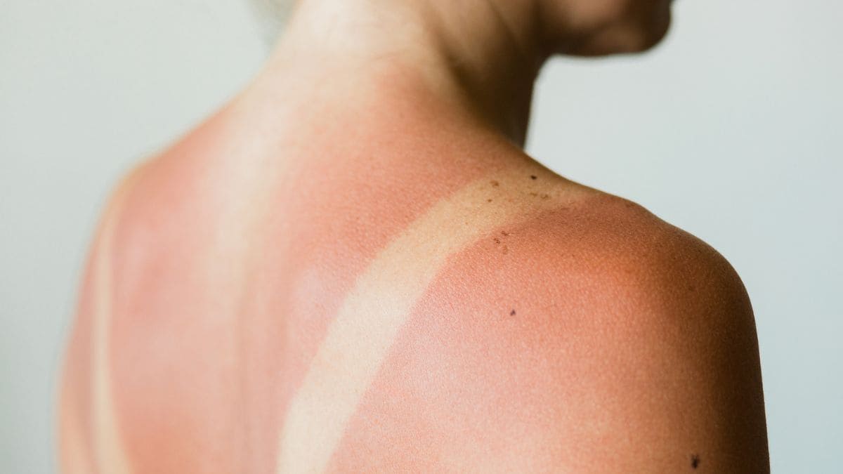 Qué hacer quemadura verano