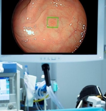 Colonoscopia y test de sangre oculta, igual de eficaces contra cáncer colorrectal
