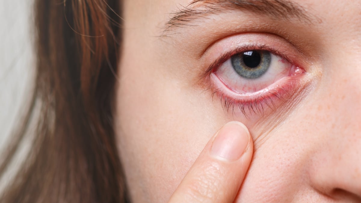 Qué necesitas para evitar la conjuntivitis este verano