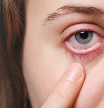 Qué necesitas para evitar la conjuntivitis este verano