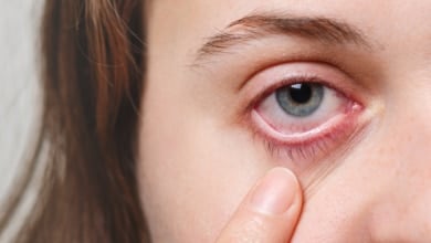 Qué necesitas para evitar la conjuntivitis este verano