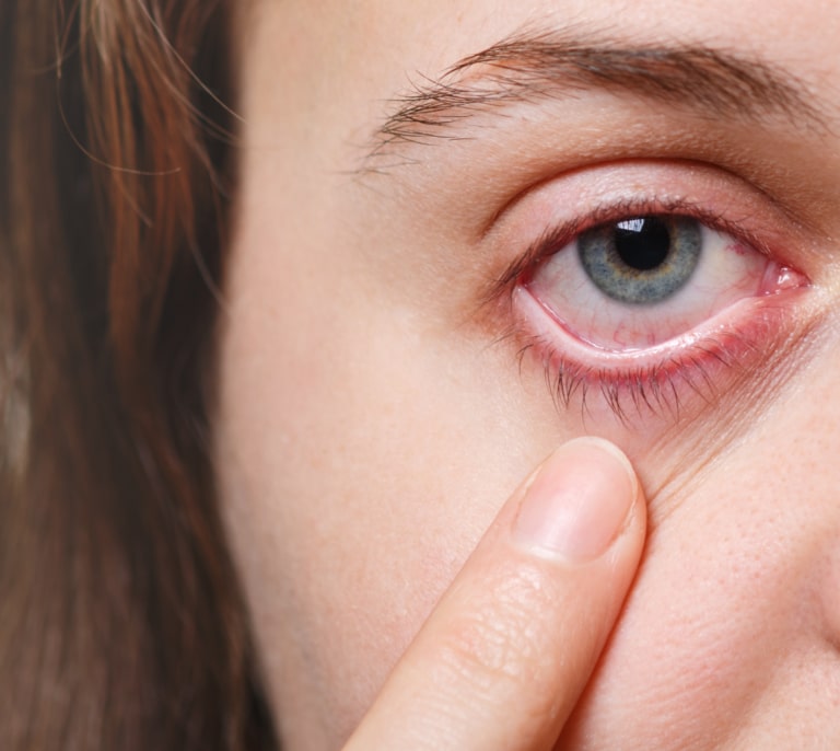Qué necesitas para evitar la conjuntivitis este verano