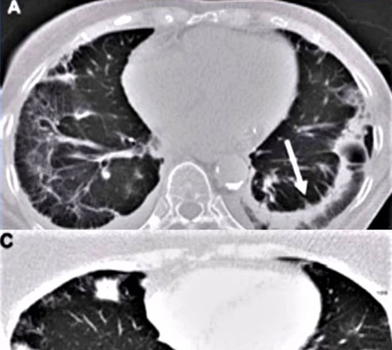 Dos ensayos clínicos mundiales con 142 pacientes españoles en 26 hospitales contribuyen a acercar nuevas soluciones para la fibrosis pulmonar
