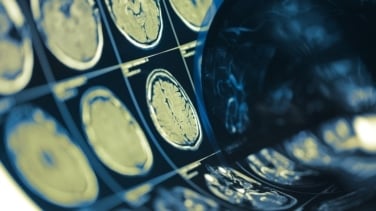 El duelo y el estrés económico se asocian con alteraciones cerebrales vinculadas al alzhéimer, según un estudio