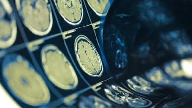 El duelo y el estrés económico se asocian con alteraciones cerebrales vinculadas al alzhéimer, según un estudio