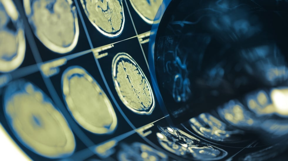 El duelo y el estrés económico se asocian con alteraciones cerebrales vinculadas al alzhéimer, según un estudio