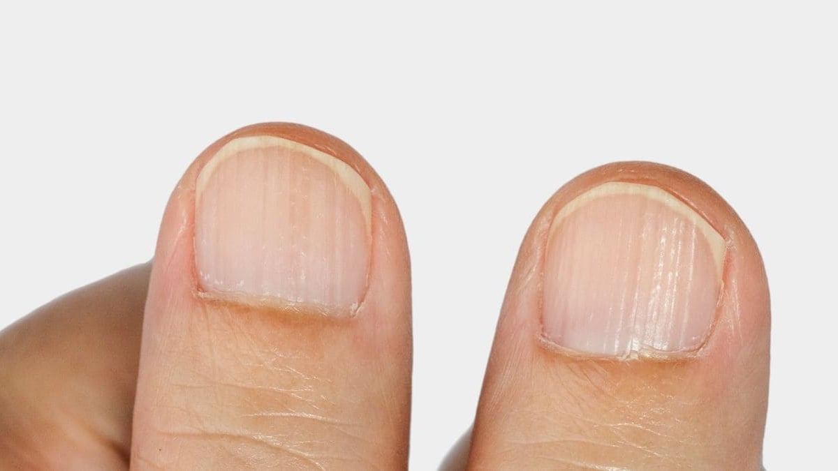 Uñas rayas