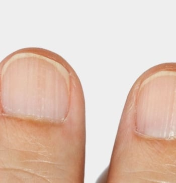 Uñas rayas