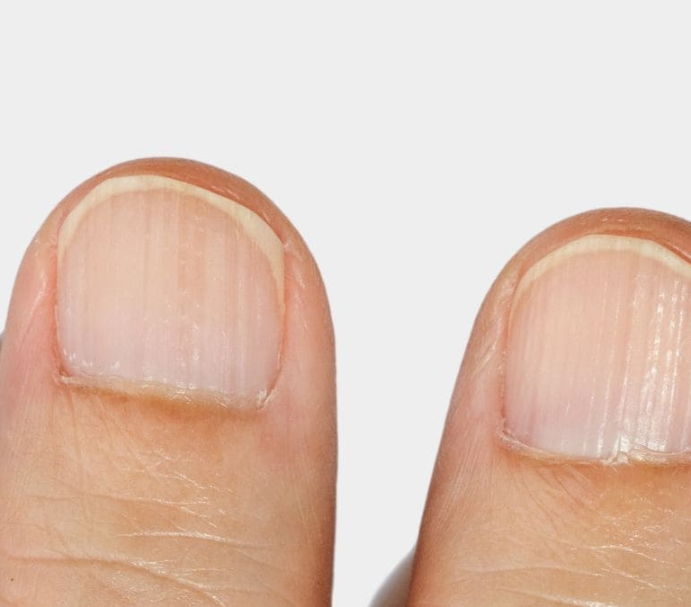 ¿Tienes las uñas con rayas? Este es el motivo