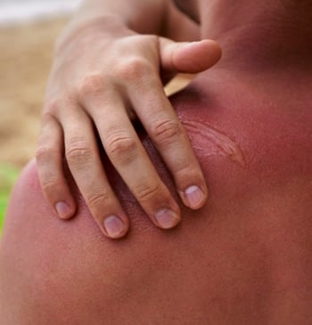 ¿Qué precauciones debes tomar ante los incidentes de verano?