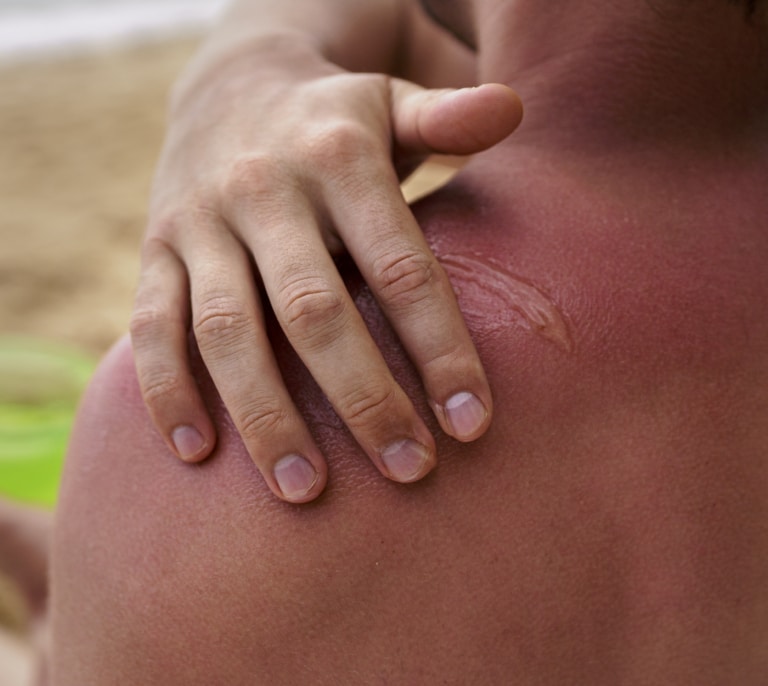 ¿Qué precauciones debes tomar ante los incidentes de verano?