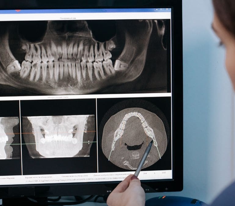 Las consecuencias de no tratar el bruxismo a tiempo