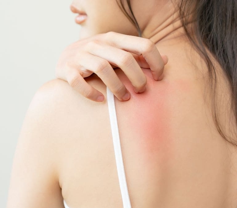 ¿Por qué cuanto más te rascas, más te pica?